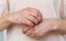 Najveća epidemija ospica u posljednjih 30 godina